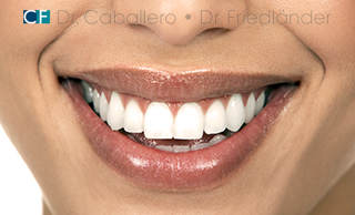 blanqueamiento dental barcelona