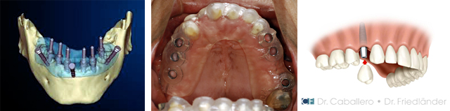 implantes dentales con cirugia no invasiva