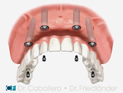 carga-inmediata-II-clinica-dental-CF-Barcelona