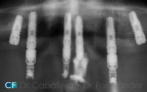 carga-inmediata-II-radiografia-clinica-dental-CF-Barcelona