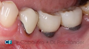 periimplantitis-II_caso-leve-clinica-dental-CF-Barcelona-300x165