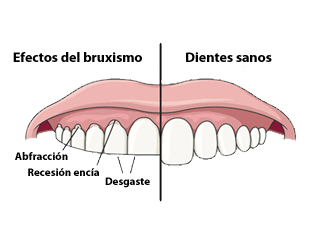 bruxismo-daños-dientes