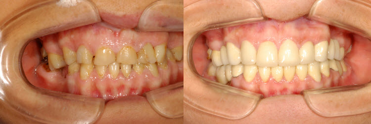 Tratamiento Bruxismo – Clínica Odontológica DentoBeli