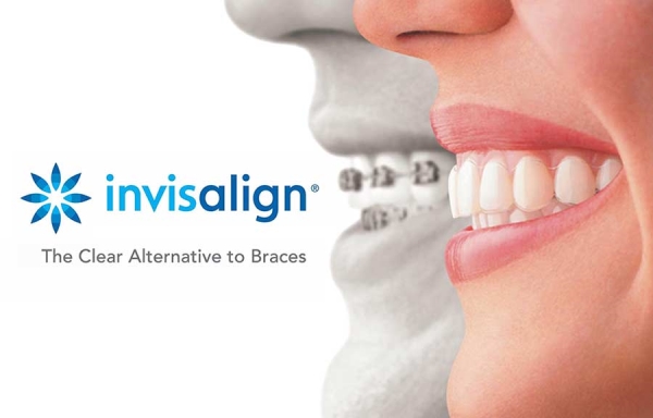 Que Es Invisalign Tipos Y Tratamientos