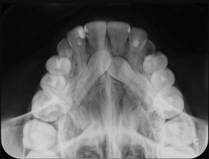 radiografia oclusal