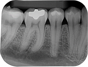 radiografia periapical