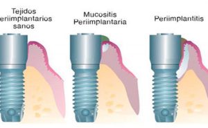 Preiimplantitis