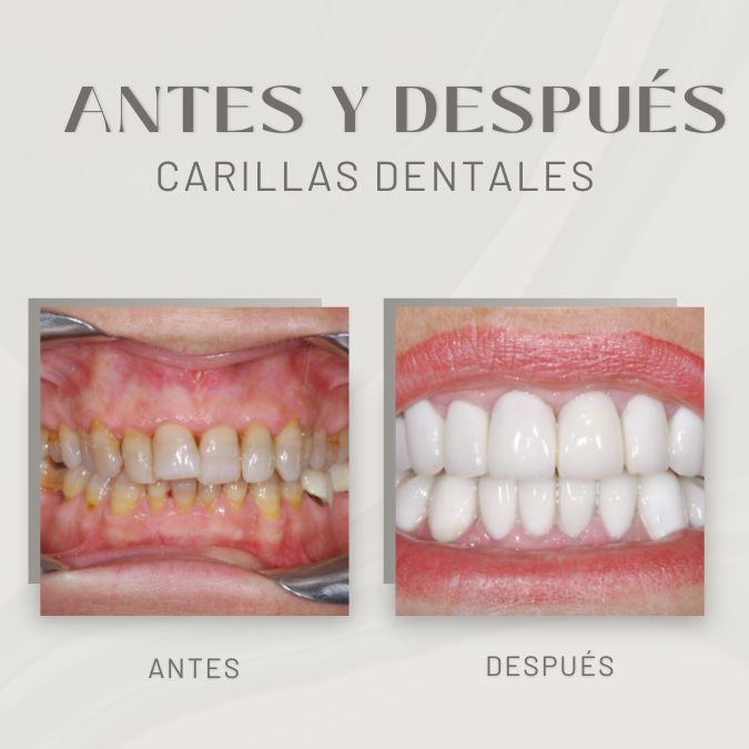 carillas dentales antes y después