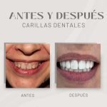 Caso Real: Transformación Dental con Carillas