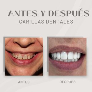 ejemplo real de carillas dentales